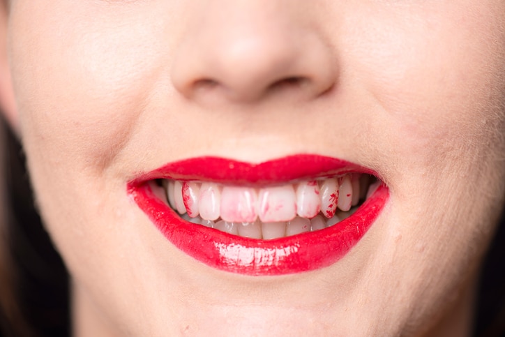 Close up of a caucasian face and mouth with red lips and lipstick on her white teeth